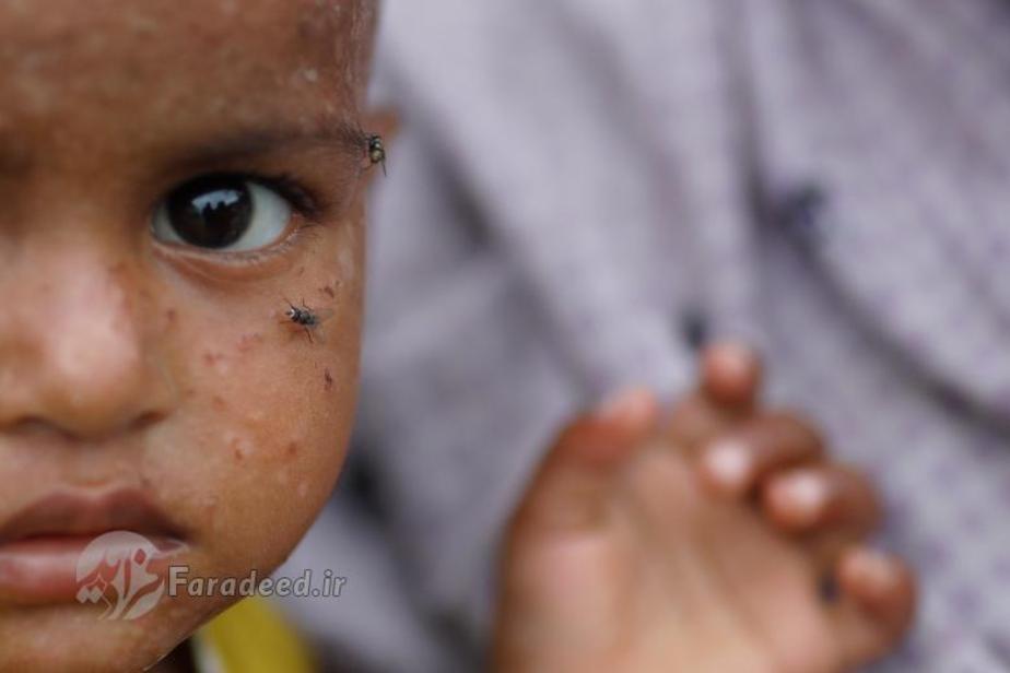 بنگلادش| مگس هایی که بر روی صورت یک دختر پناهجوی روهینگیایی نشسته اند. این دختر به همراه دیگر پناهجویان در اردوگاه پناهجویان در بنگلادش به انتظار پخش کردن بسته های کمک نشسته اند