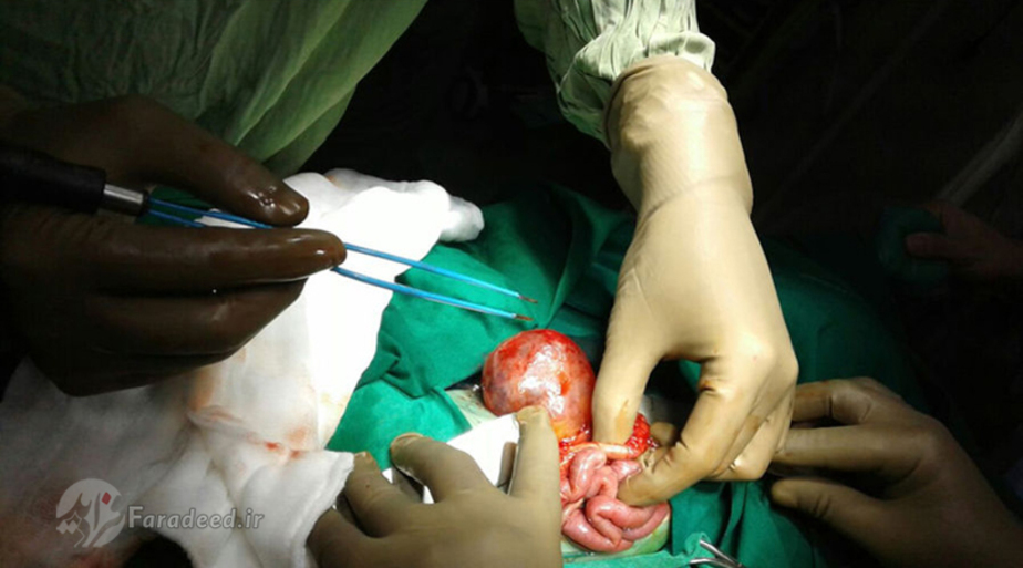 عمل جراحی برای خارج کردن توده از شکم نوزاد