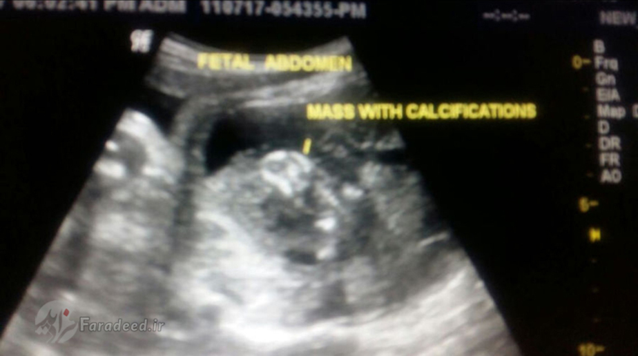 تصویر سونوگرافی از توده داخل شکم نوزاد